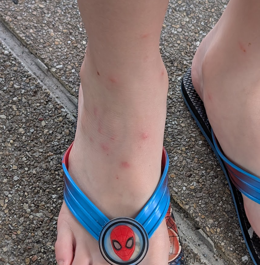 Brutal mosquito bites in Phuket
